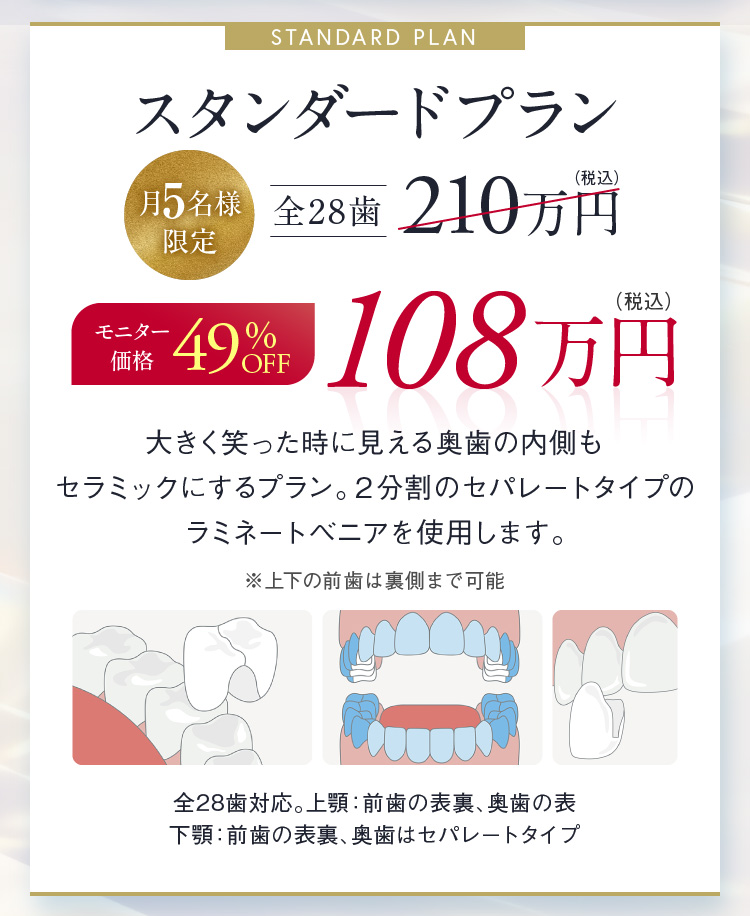 スタンダードプラン 月5名様限定 全28歯 モニター価格 49%OFF 108万円（税込）